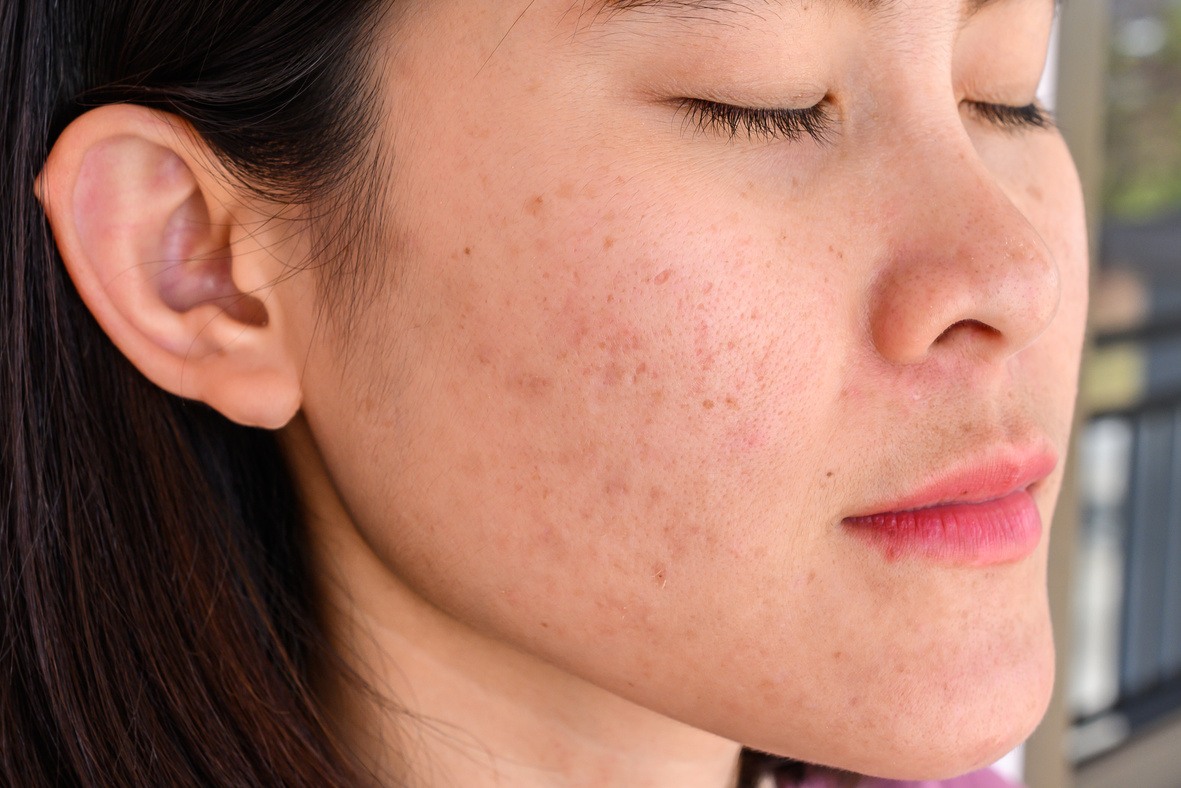 Side view close-up of woman face has variety problems on her skin (such as Acne, Pimple, Pores and Melasma etc).